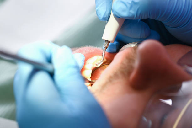 Best Dentist for Tooth Abscess  in Clarksburg, WV